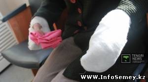 В Семее получившей обморожение девушке ампутируют конечности