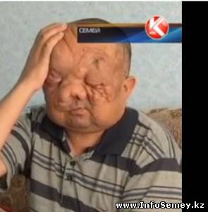 Про инвалида, страдающего из-за ядерных взрывов на Семипалатинском полигоне, власти забыли