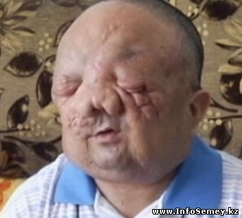 Жителю Семея в Испании удалили огромную опухоль