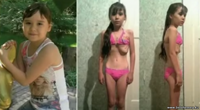 Больная анорексией юная жительница ВКО приехала на 